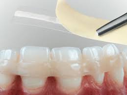 Фото к статье Подвижность зубов 6.jpg