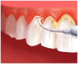 Фото к статье Основы профессиональной чистки зубов 2.jpg