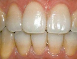 Фото к статье Профилактика зубного налета и борьба с ним 1.jpg