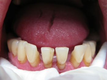 Фото к статье Подвижность зубов 3.JPG