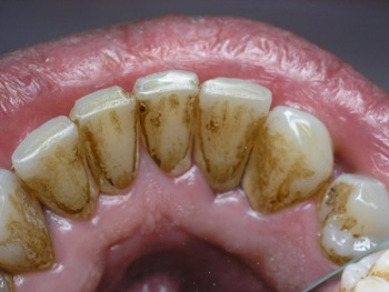 Фото к статье Народные средства против зубного камня 2.jpg