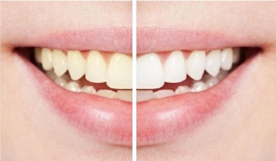 Whitening teeths 1.jpg
