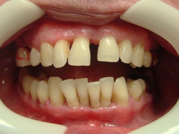 Фото к статье Подвижность зубов 4.jpg