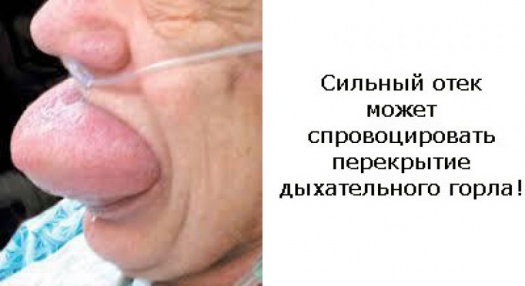 Как снять отек квинки в домашних условиях 655