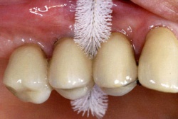 Фото к статье Профилактика зубного налета и борьба с ним 2.jpg