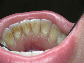 Фото к статье Как избавиться от зубного камня в домашних условиях 2.jpg
